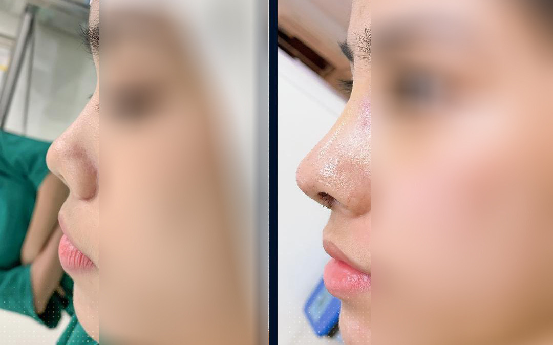 Nâng mũi an toàn với phương pháp cấu trúc tại TMV MERA