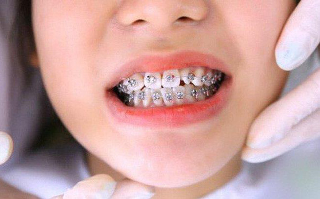 4 điều ba mẹ cần làm nếu muốn con niềng không phải nhổ răng