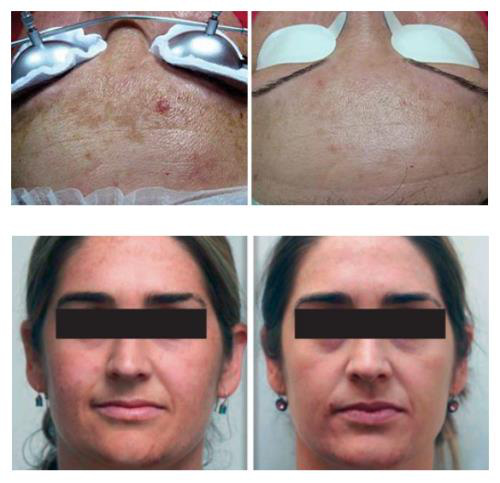Pensilia Beauty Clinic chính thức áp dụng Fotona Starwalker MaQx vào điều trị da: Tích hợp 8 công nghệ, cải thiện làn da một cách vượt trội - Ảnh 3.