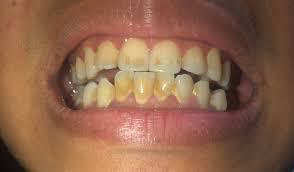 Các phương pháp tẩy trắng răng hiệu quả ai cũng nên biết - Ảnh 1.
