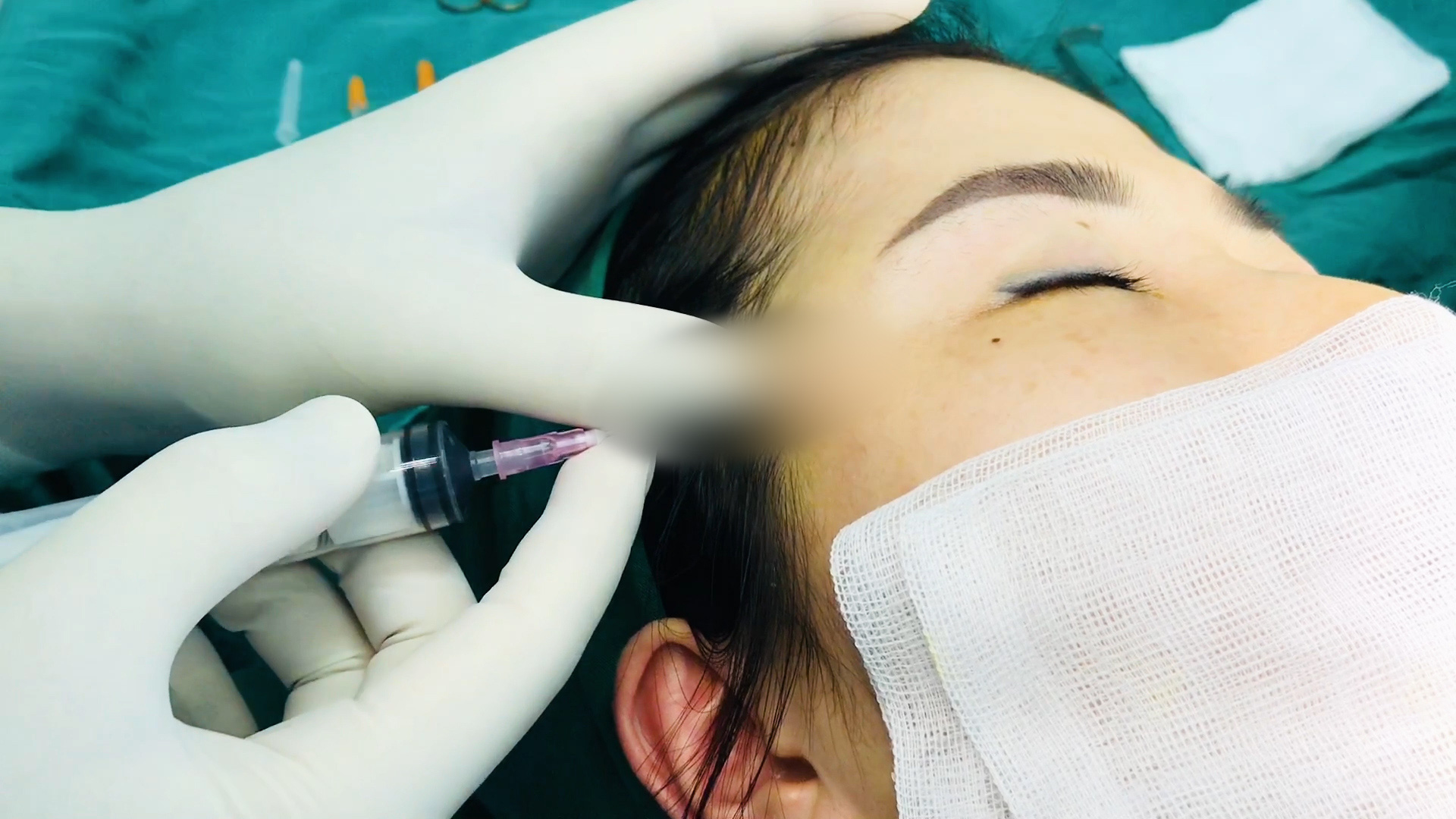 Rùng mình dịch mủ chảy ào ạt khi bác sĩ nạo filler cho một nạn nhân làm đẹp tại spa - Ảnh 2.