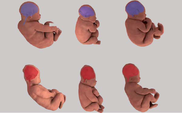 Kinh ngạc với hình ảnh MRI cho thấy đầu của em bé đã &quot;biến dạng&quot; như thế nào khi mẹ sinh thường