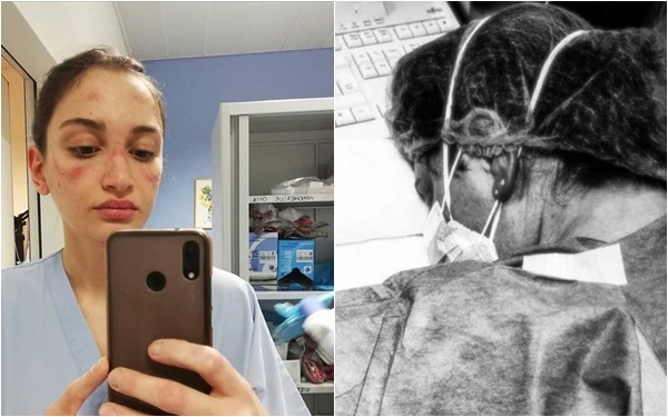Nữ y tá với vết bầm trên mặt lột tả cuộc chiến khốc liệt chống Covid-19 ở Italy: Ngủ gục trên bàn vì quá mệt, không thể đi vệ sinh hay uống nước suốt 6 giờ