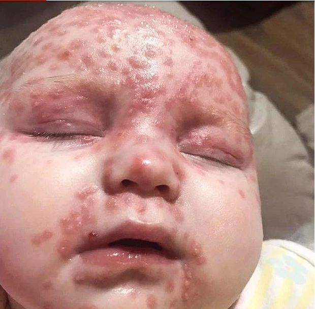 Rùng mình khi nhìn bé gái 6 tháng tuổi bị nhiễm virus Herpes dù mẹ đã cấm tất cả mọi người hôn con - Ảnh 2.