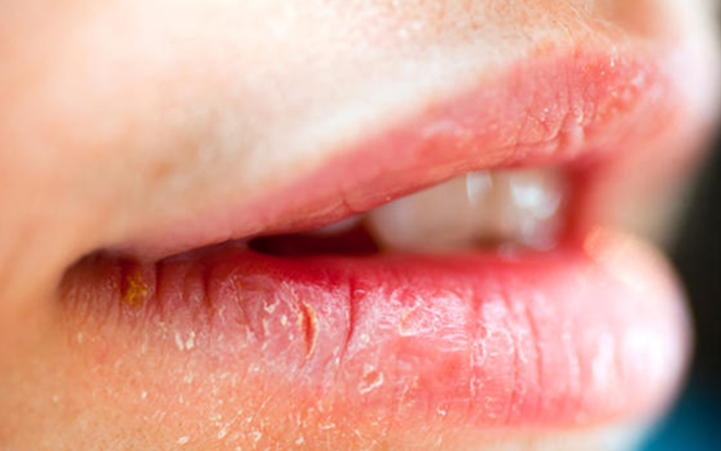 8 tuyệt chiêu đơn giản trị khô môi siêu hiệu quả có thể làm tại nhà, chị em nên đọc để lấy lại sự căng bóng cho đôi môi