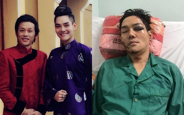 Con trai nuôi Hoài Linh bị tai nạn nghiêm trọng, não chấn thương nặng, vỡ xương gò má