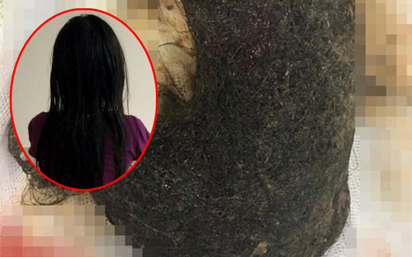Bé gái 11 tuổi ở Hà Nội có khối u khổng lồ trong cơ thể chứa toàn tóc, nguyên nhân do 1 thói quen từ năm 2 tuổi của bé 
