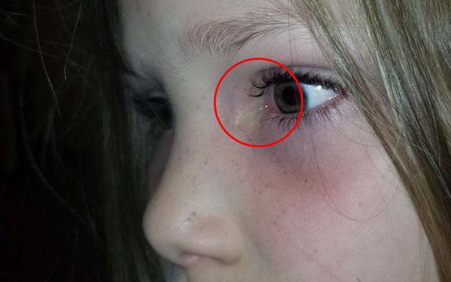 Con gái khóc giữa đêm than mắt bỏng rát, mẹ đưa đi cấp cứu thì rùng mình khi thấy một con côn trùng rơi ra khỏi mắt đứa trẻ 
