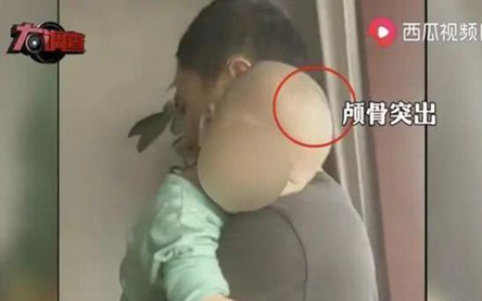 Trung Quốc: Một số trẻ em mắc bệnh "đầu to" sau khi uống 1 loại sữa công thức trong thời gian dài