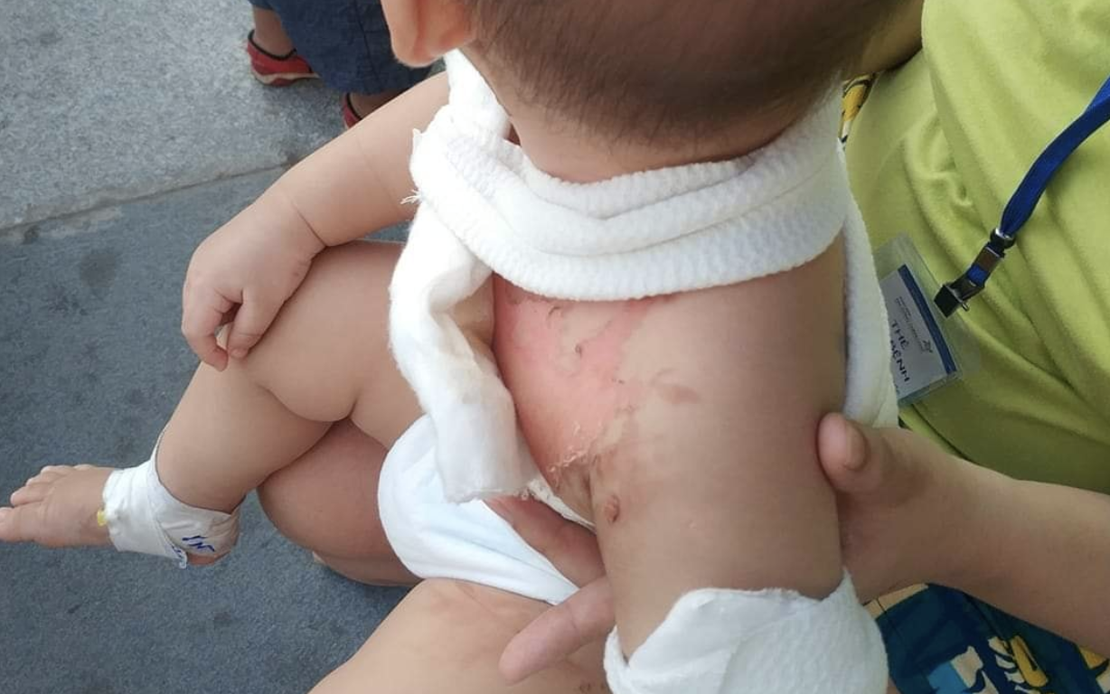 Tai nạn đau lòng: Đùa giỡn với anh trai, bé 2 tuổi bị tô mì tôm úp vào người gây bỏng nặng