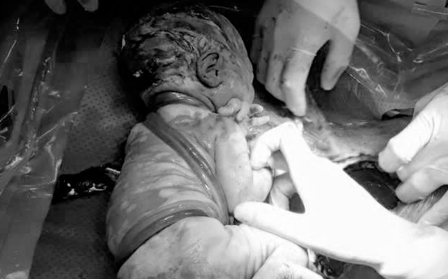 Hiếm gặp: Một em bé chào đời với 6 vòng dây rốn quấn chặt từ cổ chéo xuống bụng, bác sĩ khẳng định quá may mắn