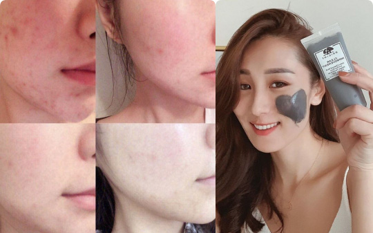 Lỗ chân lông to ngoác hay mụn đầu đen khó trị đều bị &quot;thu phục&quot; nhờ 4 dòng mask đất sét chuyên dụng cho mùa Hè