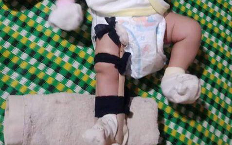 Sự thật vụ bé 2 tháng tuổi nghi bị cha ruột bạo hành tới gãy chân ở Bình Phước
