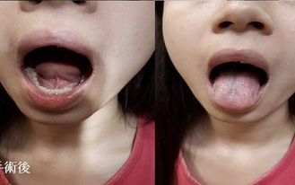 Cô gái nói chuyện không rõ, dưới lưỡi sưng phồng và có màu xanh giống như bụng nhái, bác sĩ kinh ngạc khi phát hiện khối u 6cm