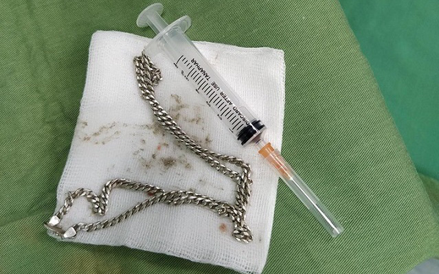 Nghệ An: Sợi dây chuyền bạc nằm trong bụng bé gái 29 tháng tuổi