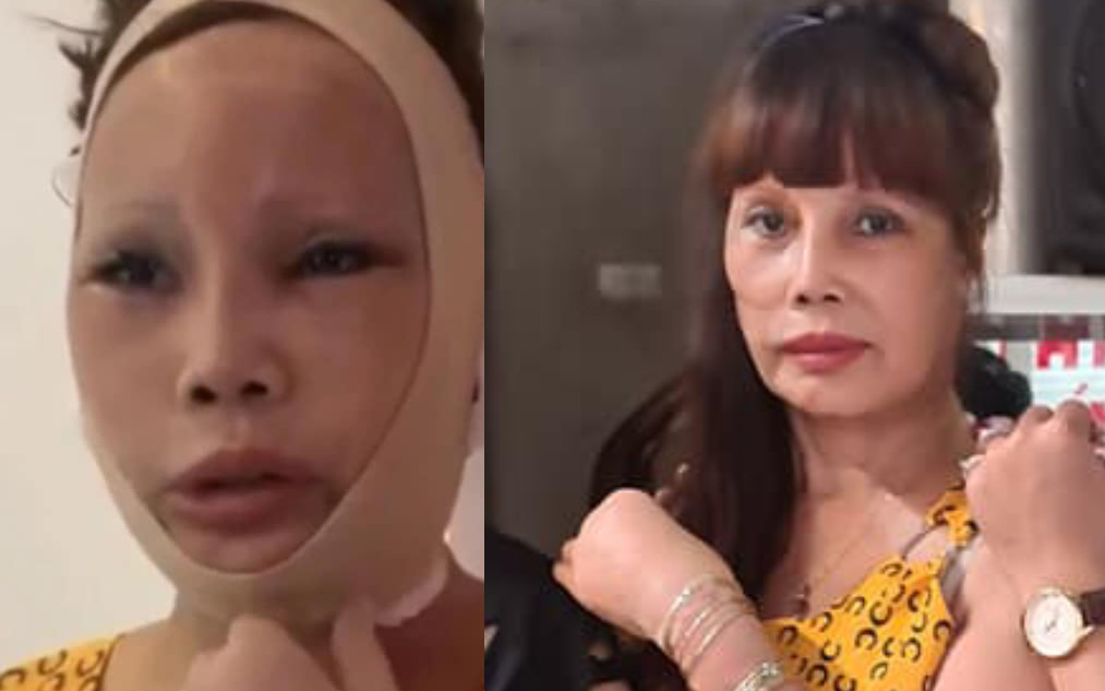 Cô dâu 62 tuổi vừa cấp cứu xong đã vội đi xăm hình, để lộ khuôn mặt sau phẫu thuật teo tóp, thiếu cân đối