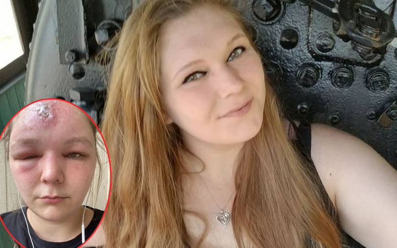 Bị ngộ độc ánh nắng sau 2 giờ ở ngoài trời, cô gái 25 tuổi đã dũng cảm "trưng bày" khuôn mặt biến dạng của mình để... mau khỏi 