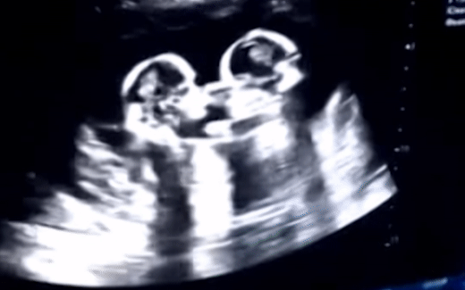 Khoảnh khắc siêu âm hiếm hoi ghi lại cú chạm nhau của 2 thai nhi song sinh trong bụng mẹ