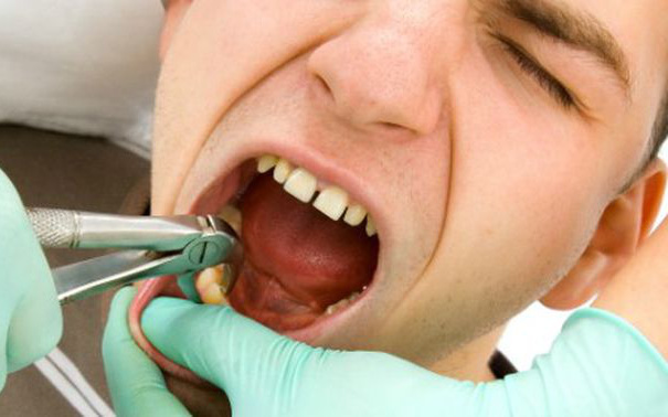 Chàng trai 26 tuổi chết vì xuất huyết não sau khi nhổ răng khôn, cảnh báo những lưu ý khi nhổ răng khôn