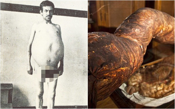 Chuyện kỳ lạ về người đàn ông bị táo bón bẩm sinh, chết khi cố đi đại tiện và ruột già được trưng bày trong bảo tàng Mỹ gây &quot;sởn da gà&quot;