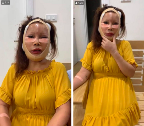 Sau nửa năm dao kéo, cô dâu 62 tuổi ở Cao Bằng vẫn sở hữu gương mặt cứng đơ, méo lệch - Ảnh 2.