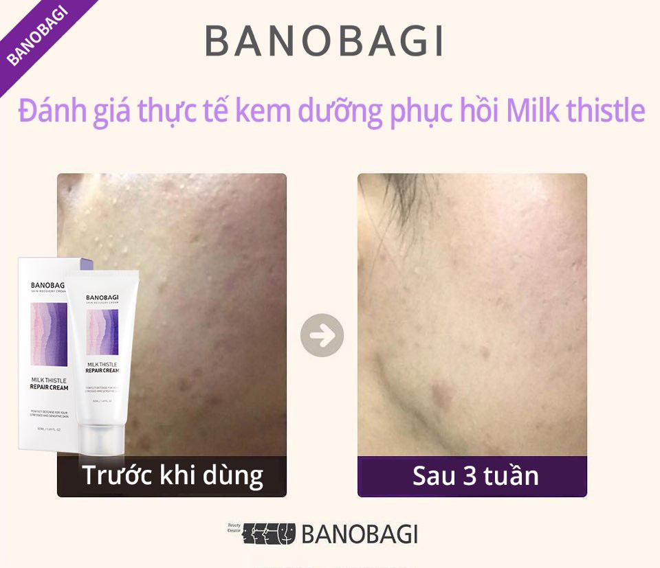 Phục hồi da khô sạm lên level hoàn hảo, khám phá ngay quy trình 5 bước của Banobagi! - Ảnh 6.