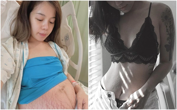 Hot mom Việt tâm sự về những vết rạn trên cơ thể: Người tự ti lẫn sợ hãi, người hạnh phúc vì "hình xăm" không phải ai cũng có được