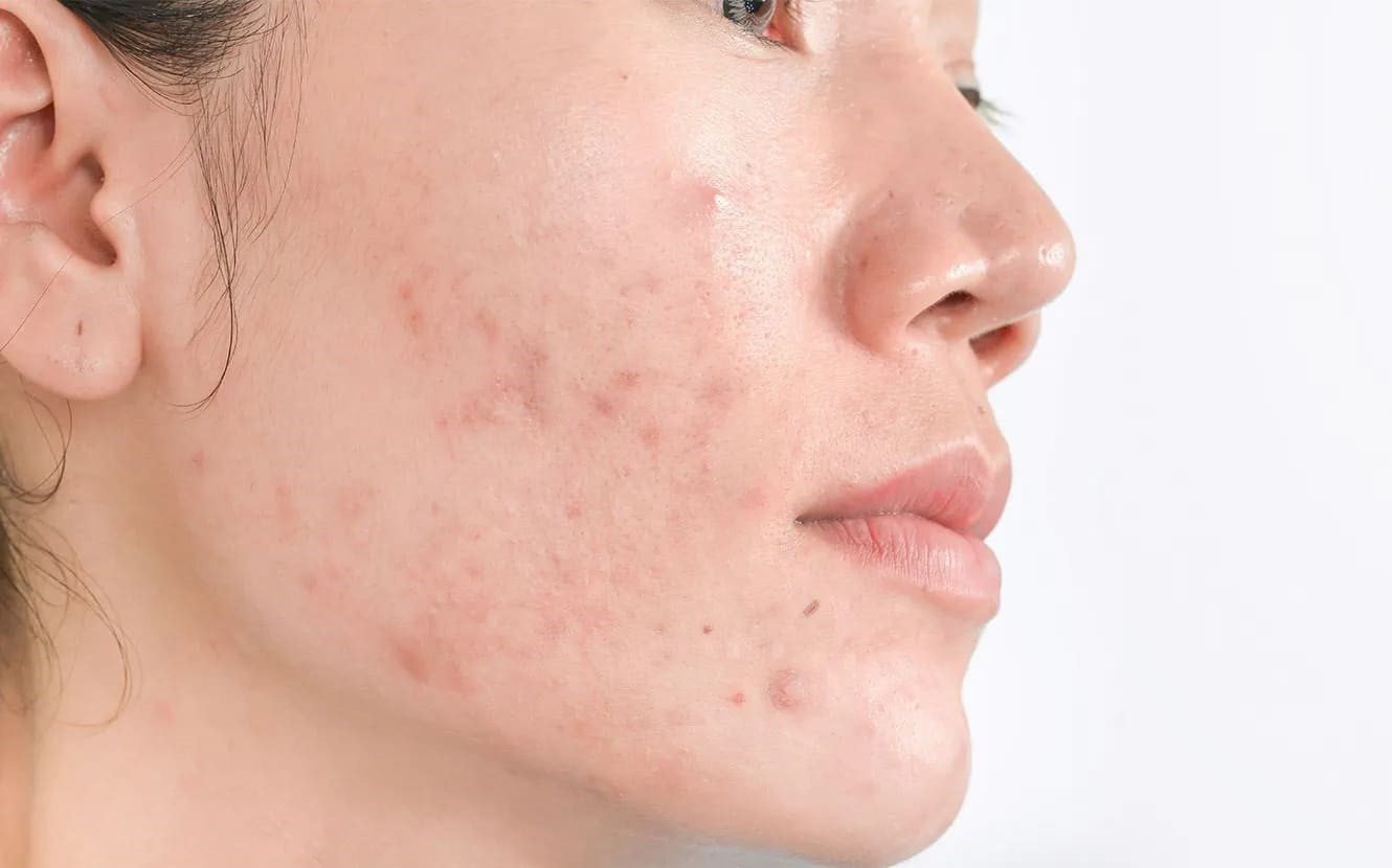 Lý do gây nên mụn ẩn và hướng điều trị hiệu quả