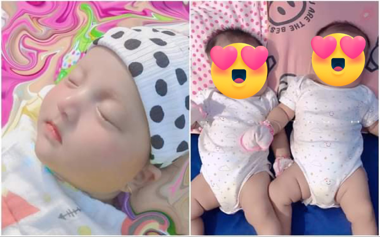 Hai bé gái sinh đôi chào đời với khuôn mặt như búp bê hiện tại thay đổi ra sao?