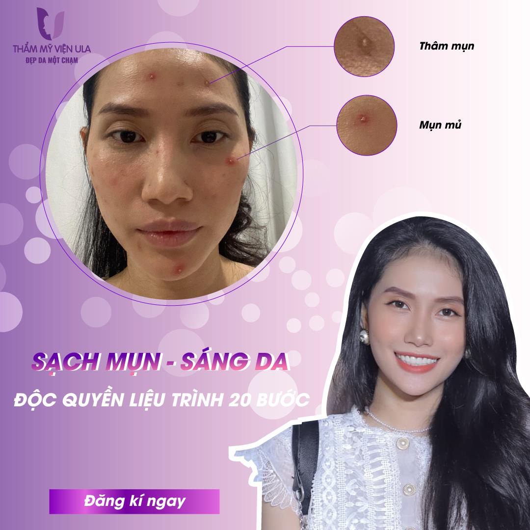Tại sao nên sử dụng dịch vụ trị mụn tại Thẩm mỹ viện Ula? - Ảnh 3.