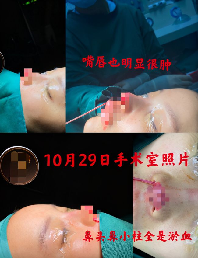 Mỹ nhân làng Hoa ngữ bị hoại tử mũi do "dao kéo" hỏng, tiết lộ 4 điều cần lưu ý trước khi phẫu thuật sửa mũi - Ảnh 2.