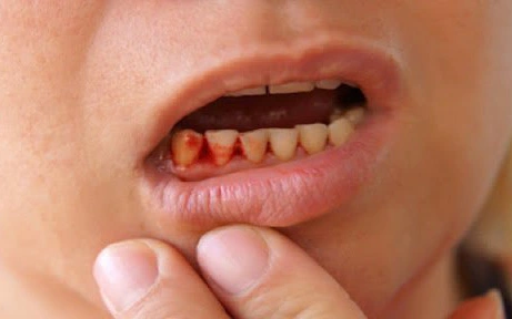 Có 4 dấu hiệu này ở miệng thì coi chừng cao răng đang 