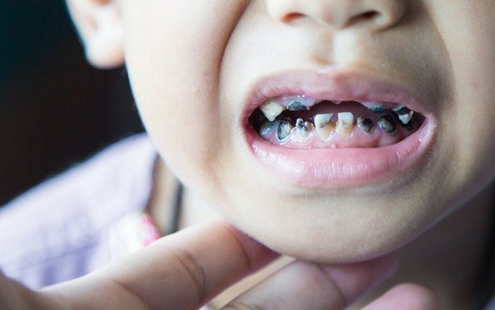 Trẻ bị sâu răng nguy hiểm hơn cha mẹ nghĩ, đây là 5 mối nguy hại khi răng trẻ bị hiện tượng này từ sớm