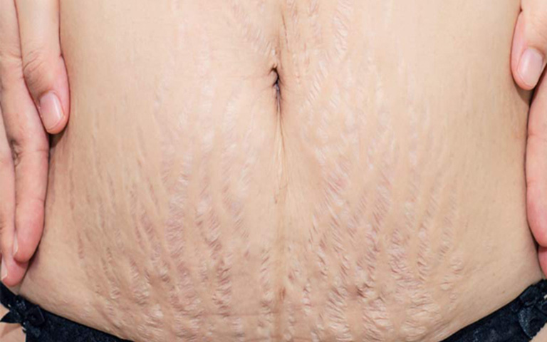 Điều trị rạn da sau sinh bằng laser có những ưu điểm gì?