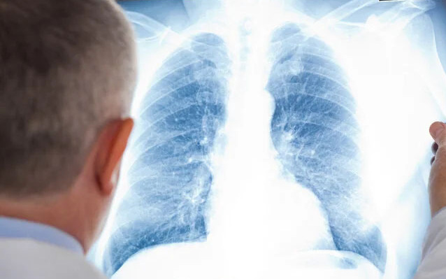 Bác sĩ bị ung thư phổi đã di căn não, sau 10 năm vẫn sống khỏe đã đúc kết 2 kinh nghiệm