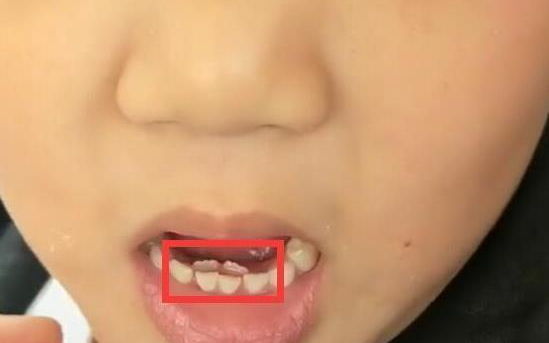 Bé gái 8 tuổi tự nhiên kêu đau răng, bà kiểm tra thấy phía trong hàm răng có "vật thể lạ"