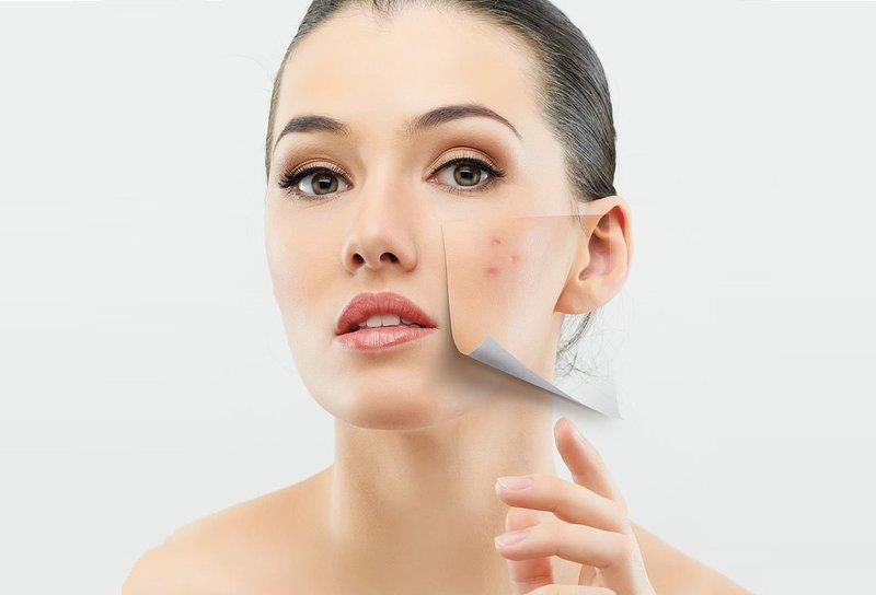 Da mụn có nên dùng kem chống nắng? - Ảnh 1.