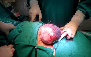 Xem tận mắt clip em bé sinh ra còn nằm trong túi ối do bác sĩ BV phụ sản Hà Nội chia sẻ, các mẹ chỉ biết thốt lên 2 từ: Kỳ diệu!