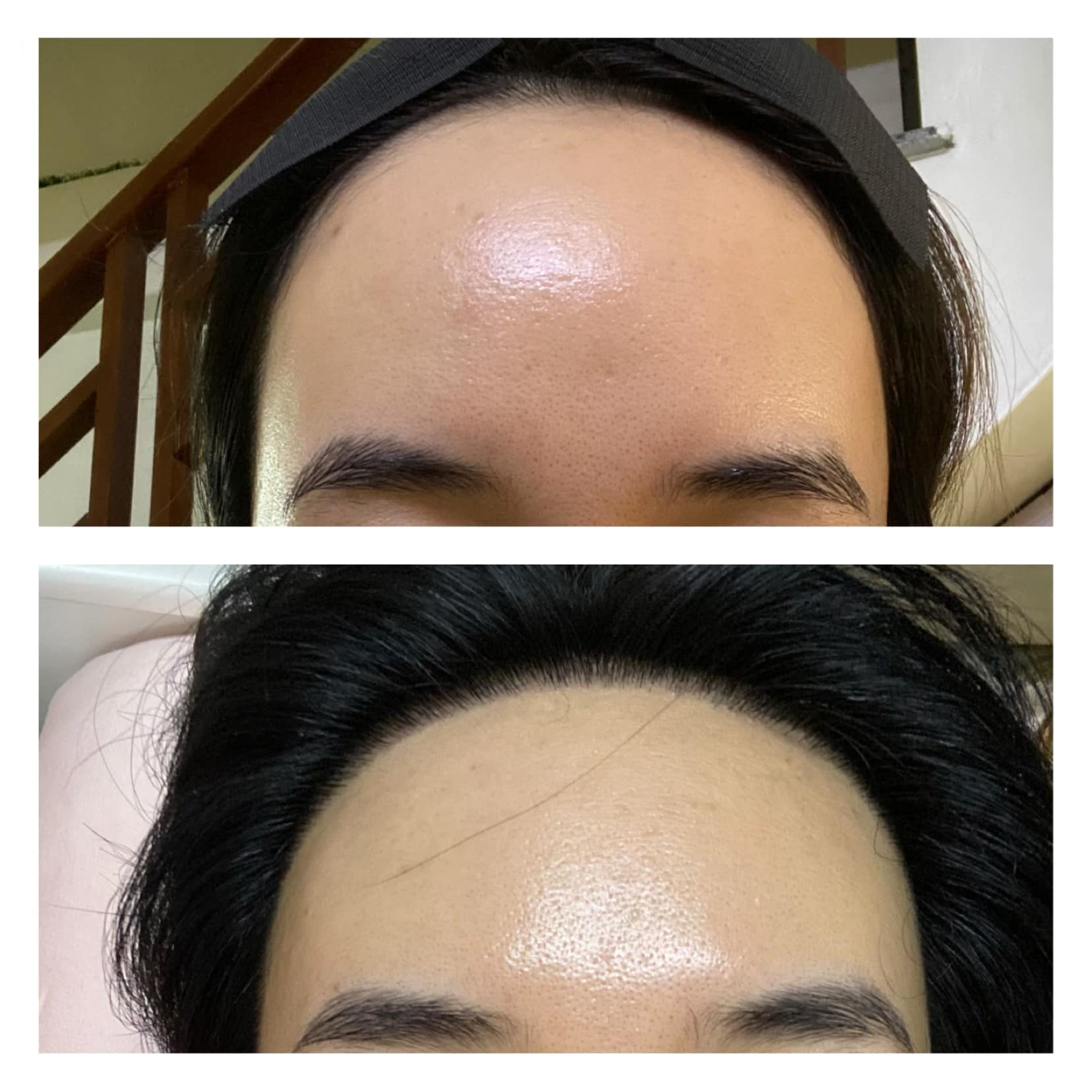 Chi 90 triệu để cấy 2cm tóc trị trán dô: Từng bất an cực độ vì tóc rụng lả tả, nhưng vài tháng sau lại cho kết quả mê ly không ngờ - Ảnh 5.