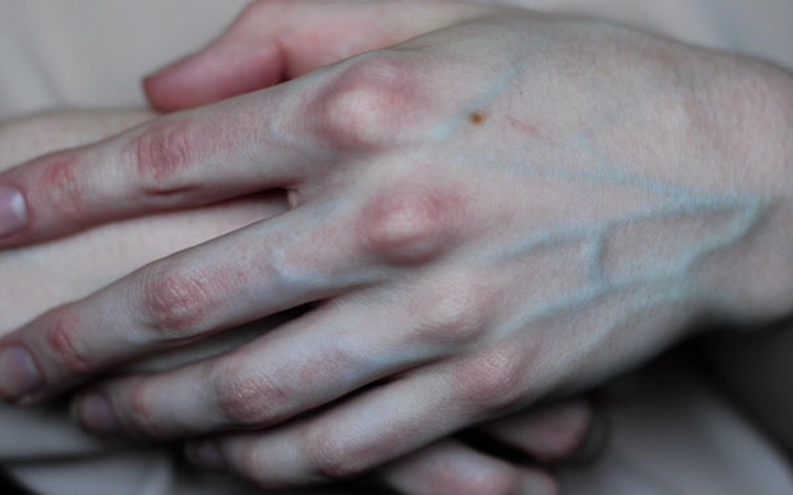 Có 4 dấu hiệu này xuất hiện trên bàn tay, cảnh báo mạch máu bị tắc nghẽn
