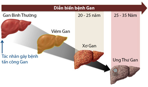 Những nguy cơ khiến gan bị tổn thương và cách bảo vệ, hỗ trợ tăng cường chức năng gan - Ảnh 1.