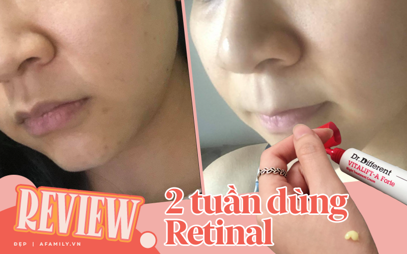 Trải nghiệm 2 tuần dùng Retinal: Vết thâm trên da mình mờ nhanh và bất ngờ nhất là mụn ẩn giảm rõ 