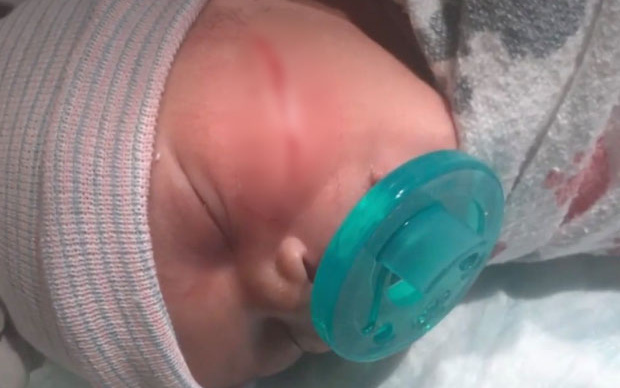 Bé gái vừa chào đời đã phải khâu 13 mũi vì bị bác sĩ rạch vào mặt trong lúc mổ đẻ