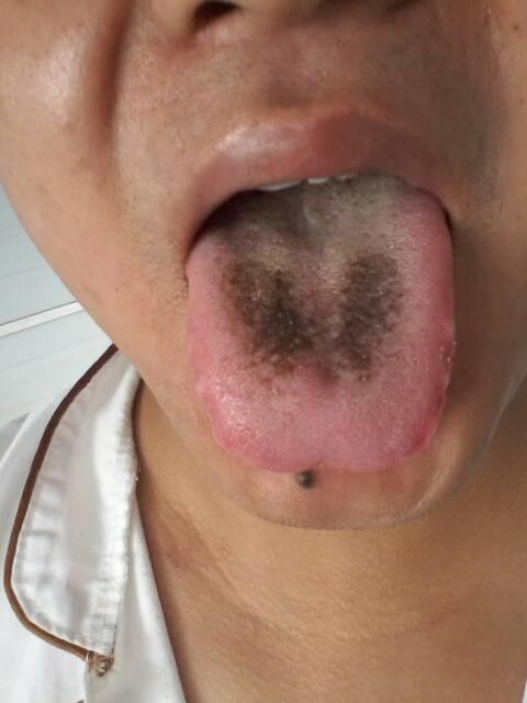 Tự nhìn lưỡi "chẩn bệnh": Có những dấu hiệu sau đồng nghĩa cơ thể đang bị ốm, cần khẩn trương đi khám - Ảnh 4.
