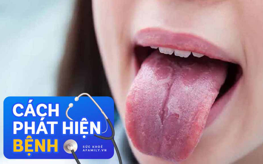Tự nhìn lưỡi &quot;chẩn bệnh&quot;: Có những dấu hiệu sau đồng nghĩa cơ thể đang mắc bệnh mà không biết