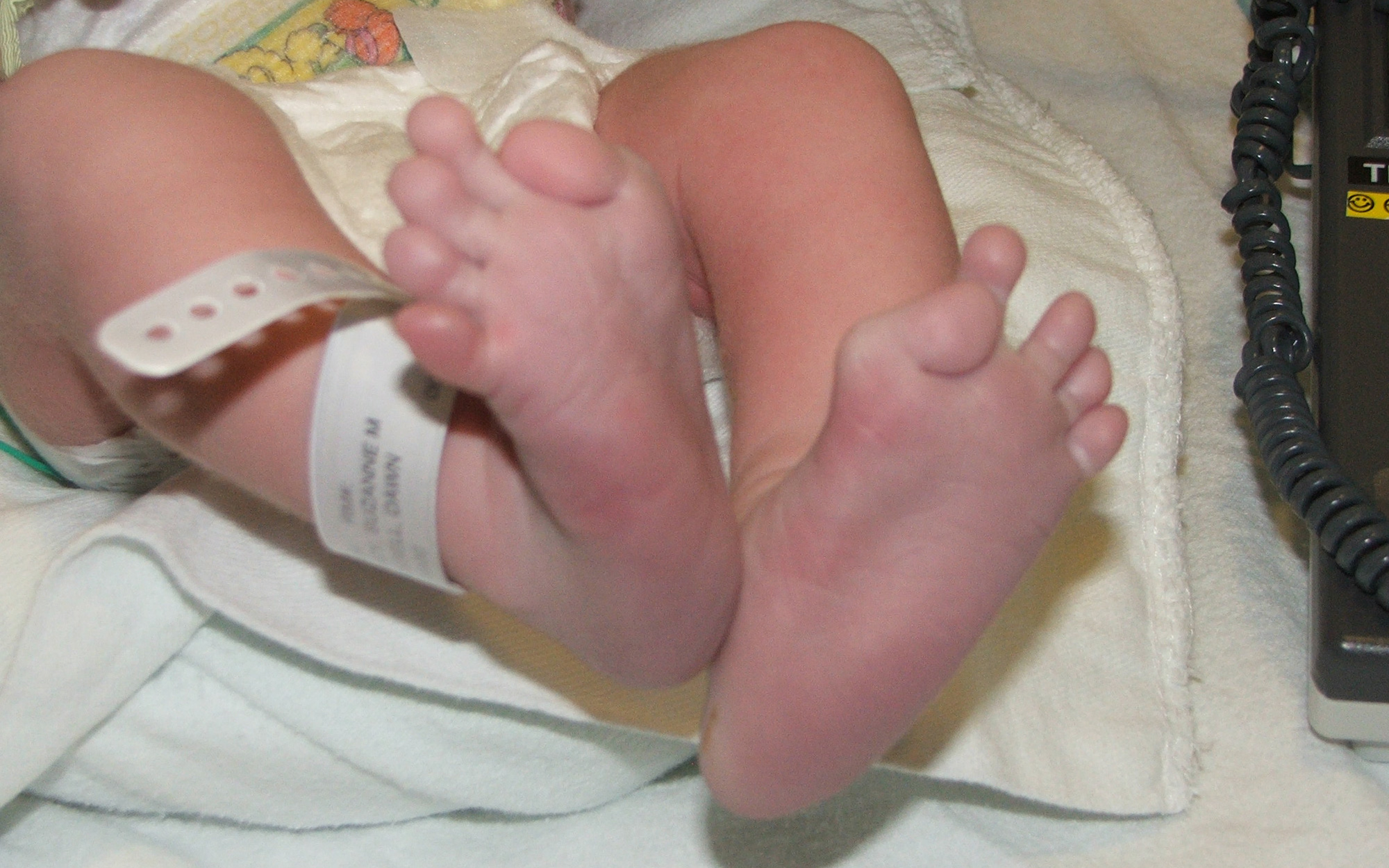 Thấy con gái mới sinh có ngón chân cái kỳ lạ, bố mẹ đi xét nghiệm rồi kinh hoàng nghe bác sĩ chẩn đoán con sẽ bị "hóa đá"