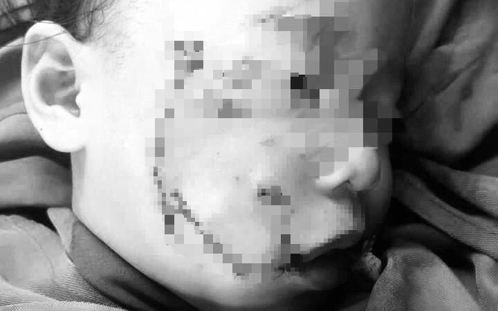 Nghệ An: Cháu bé 3 tuổi bị chó nhà cắn nát vùng mặt