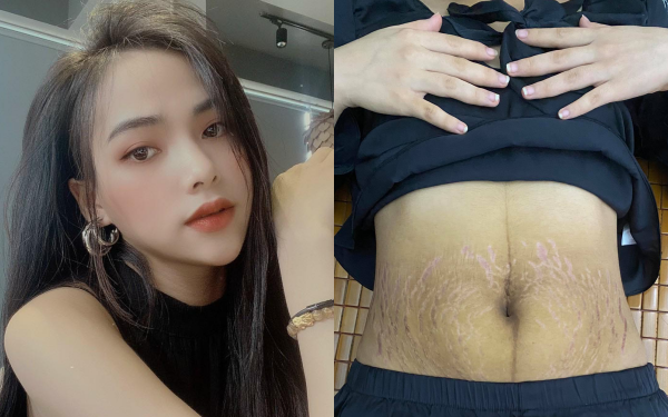 Sau sinh rạn da chằng chịt, mẹ bầu xinh như hot girl vẫn quyết định đẻ tiếp vì điều này