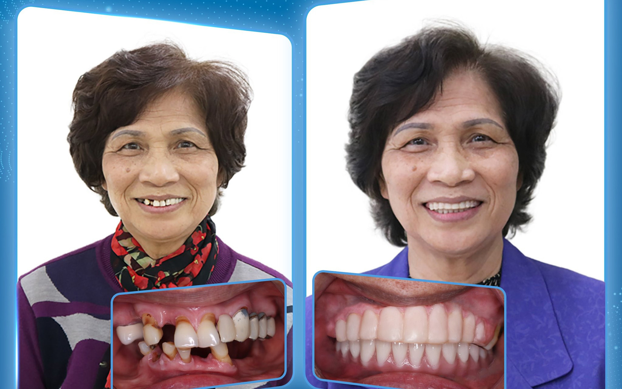 Trồng răng Implant cho răng chắc khỏe, vui Tết sum vầy