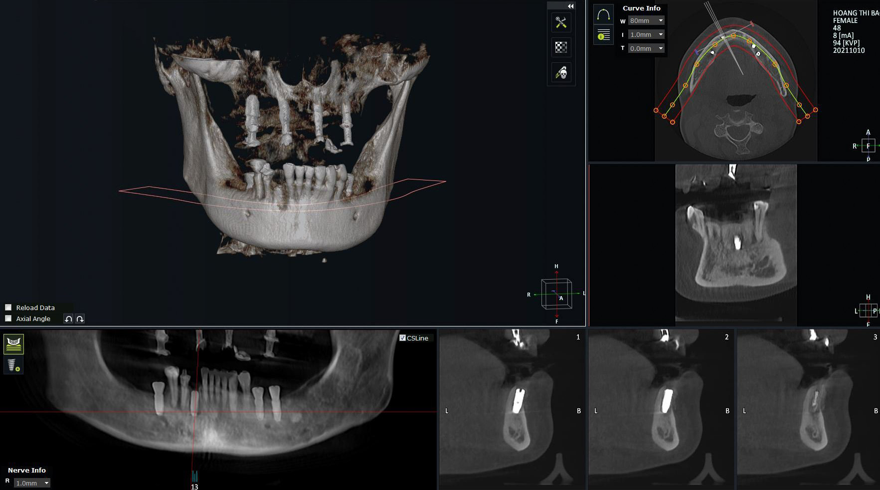 20 năm mất răng và hành trình tìm lại hạnh phúc nhờ trồng răng Implant - Ảnh 1.